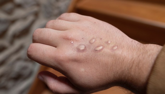 Eruzione cutanea Mpox